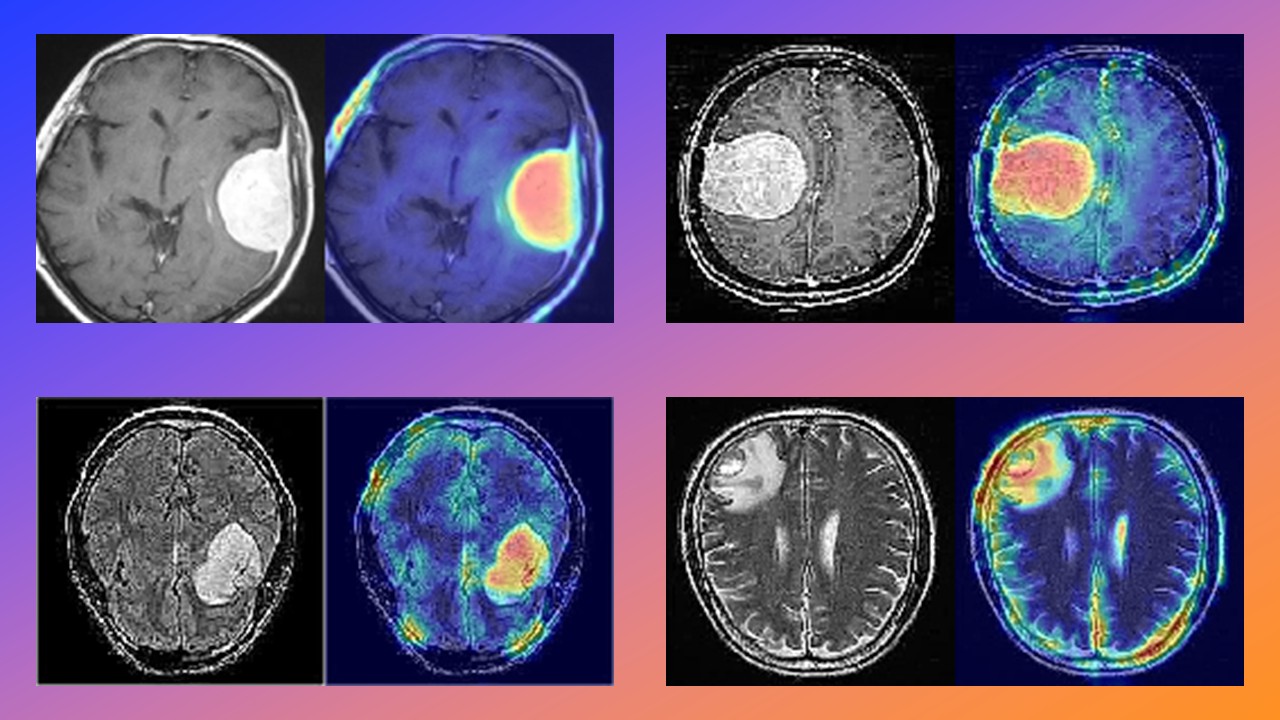 Grad-CAM heatmaps overlaid on brain MRI scans
