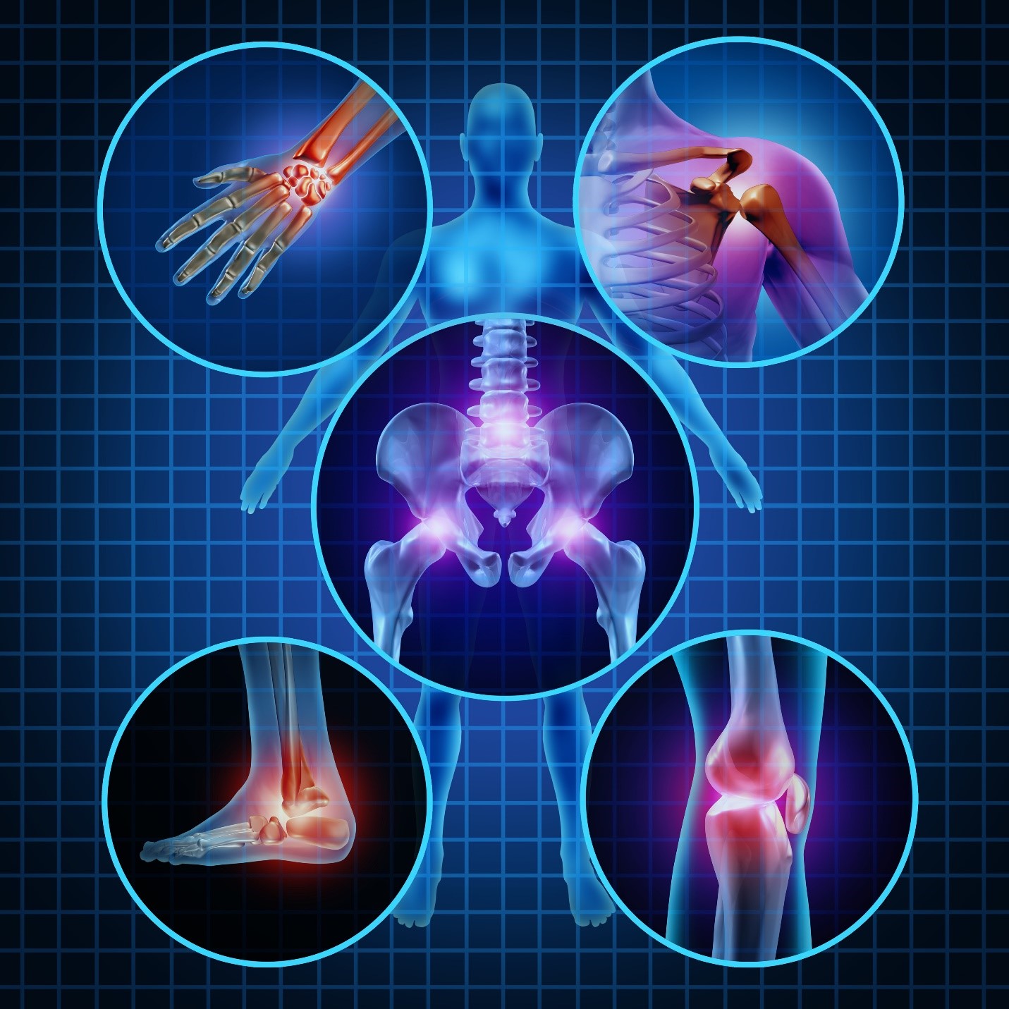 Rheumatoid Arthritis