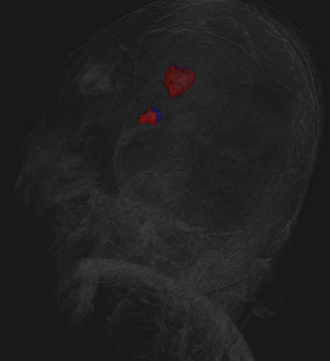 Visualisation réelle des tumeurs