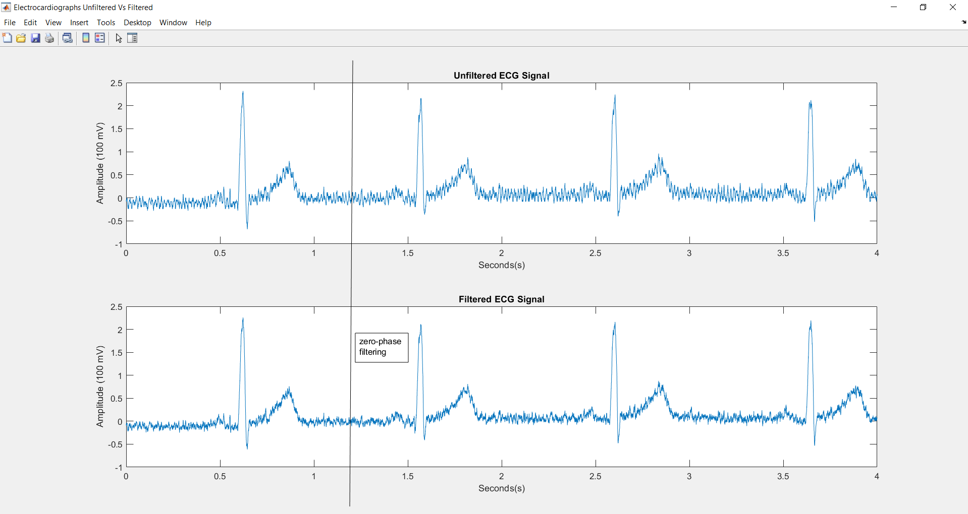  ECG Chart Zero Phase 