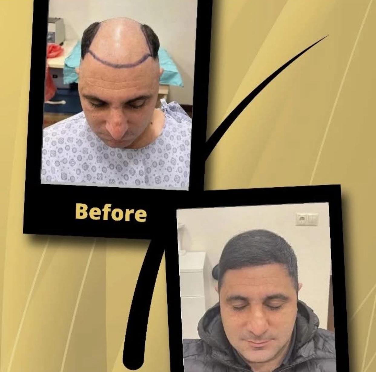 Bosgar Clinic - Procedure Result