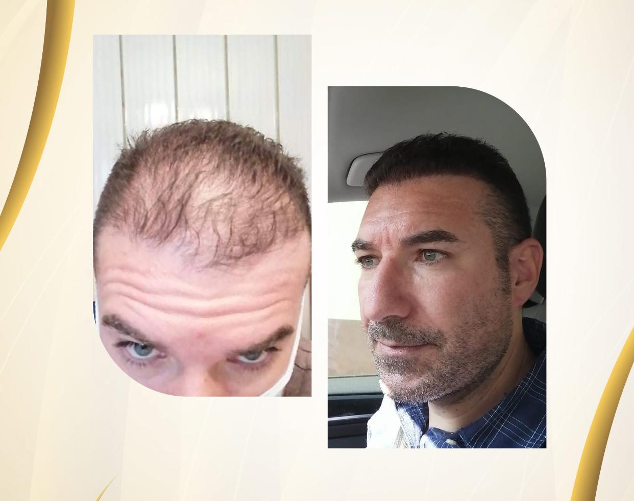 Hair Transplant Result 1