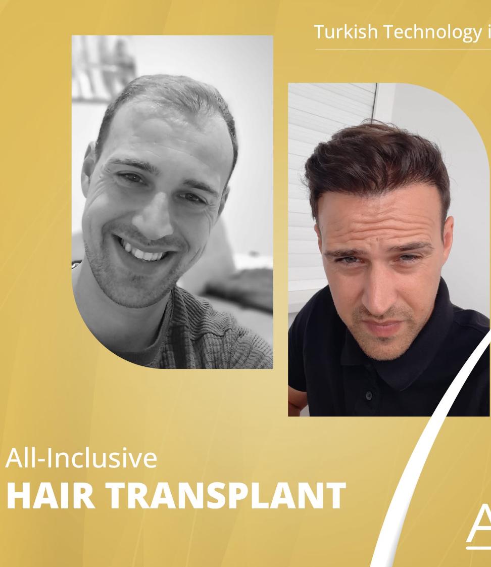 Hair Transplant Result 2