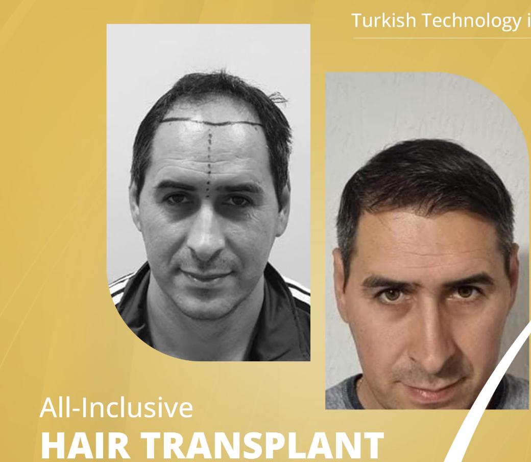 Hair Transplant Result 3