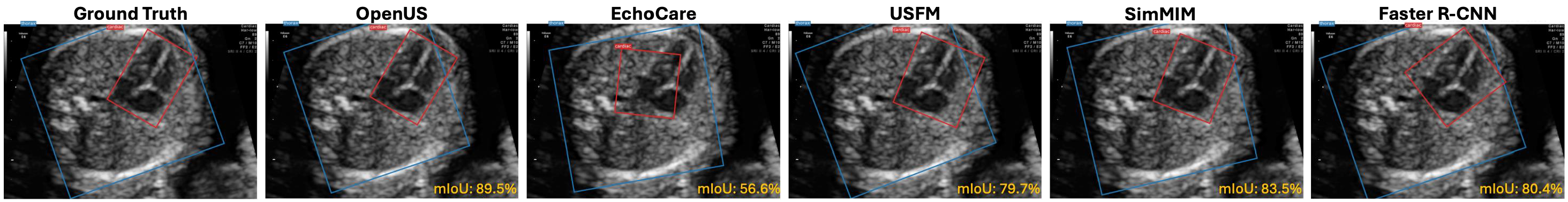 FetalCardiacDetection