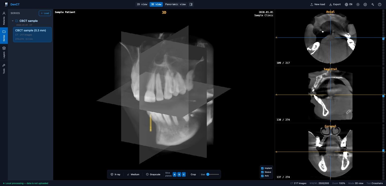DenCT 3D view: translucent X-ray volume rendering of a dental CBCT with intersecting slice planes, a planned implant and linked axial, sagittal and coronal MPR views