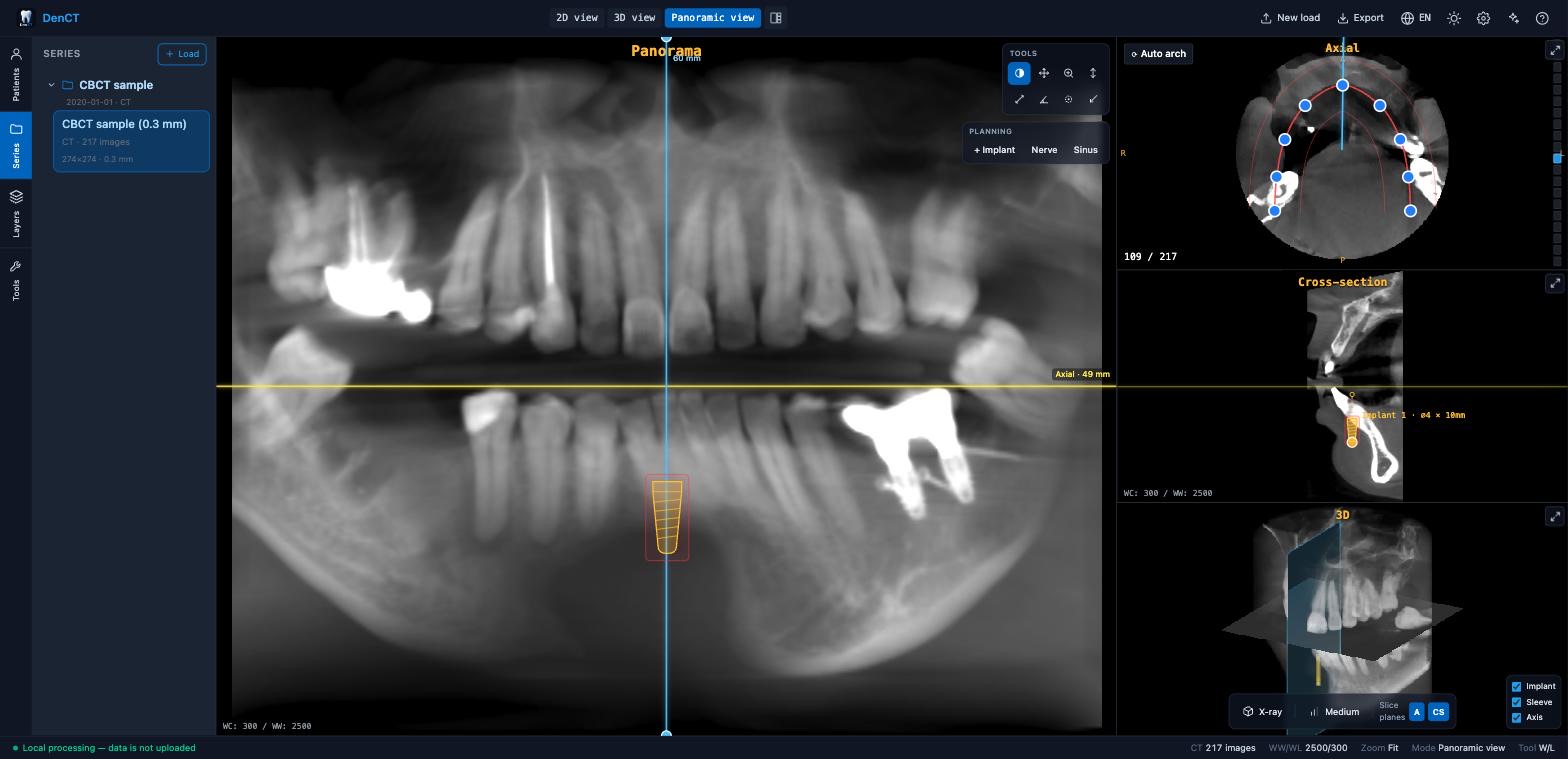 DenCT panoramic view: panoramic OPG reconstruction of a dental CBCT with a planned implant, the axial arch curve, the perpendicular cross-section and a 3D view showing where the cross-section cuts