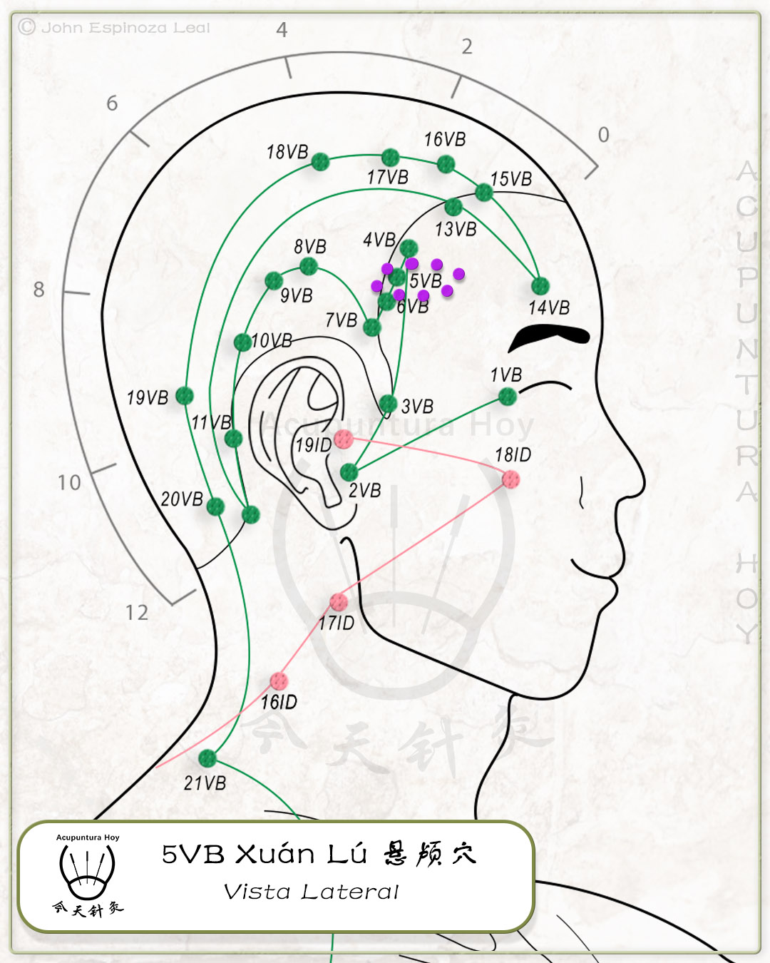 5VB Xuán Lú 悬颅穴