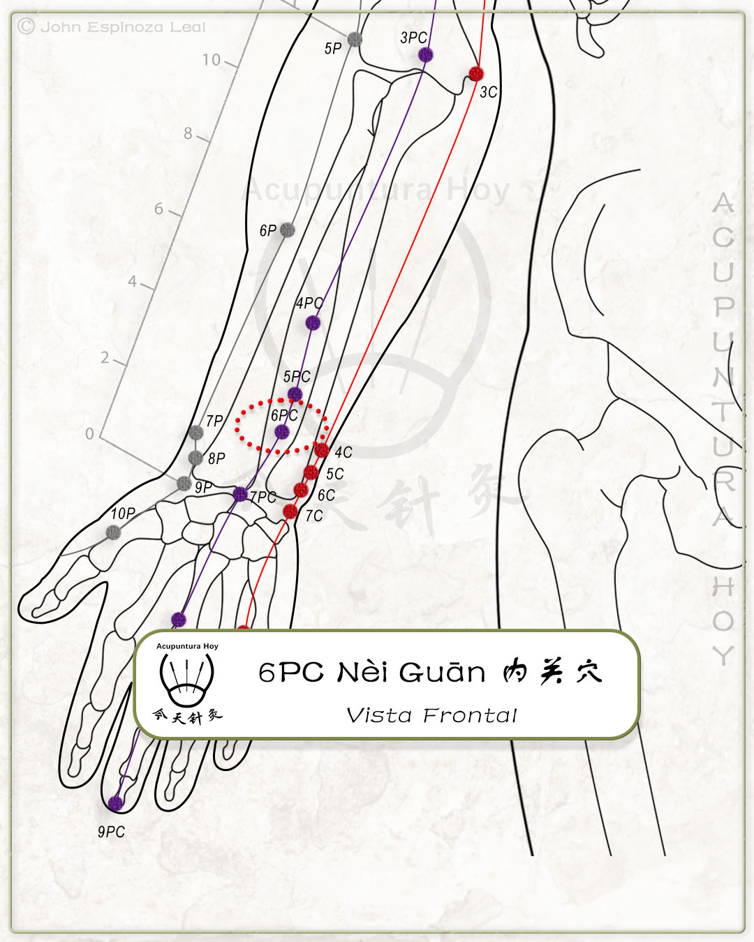 6PC Nèi Guān 内关穴
