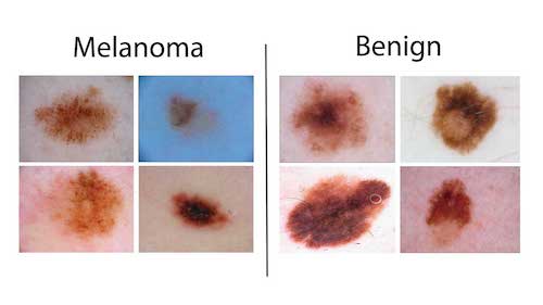 Melanoma vs Benign image