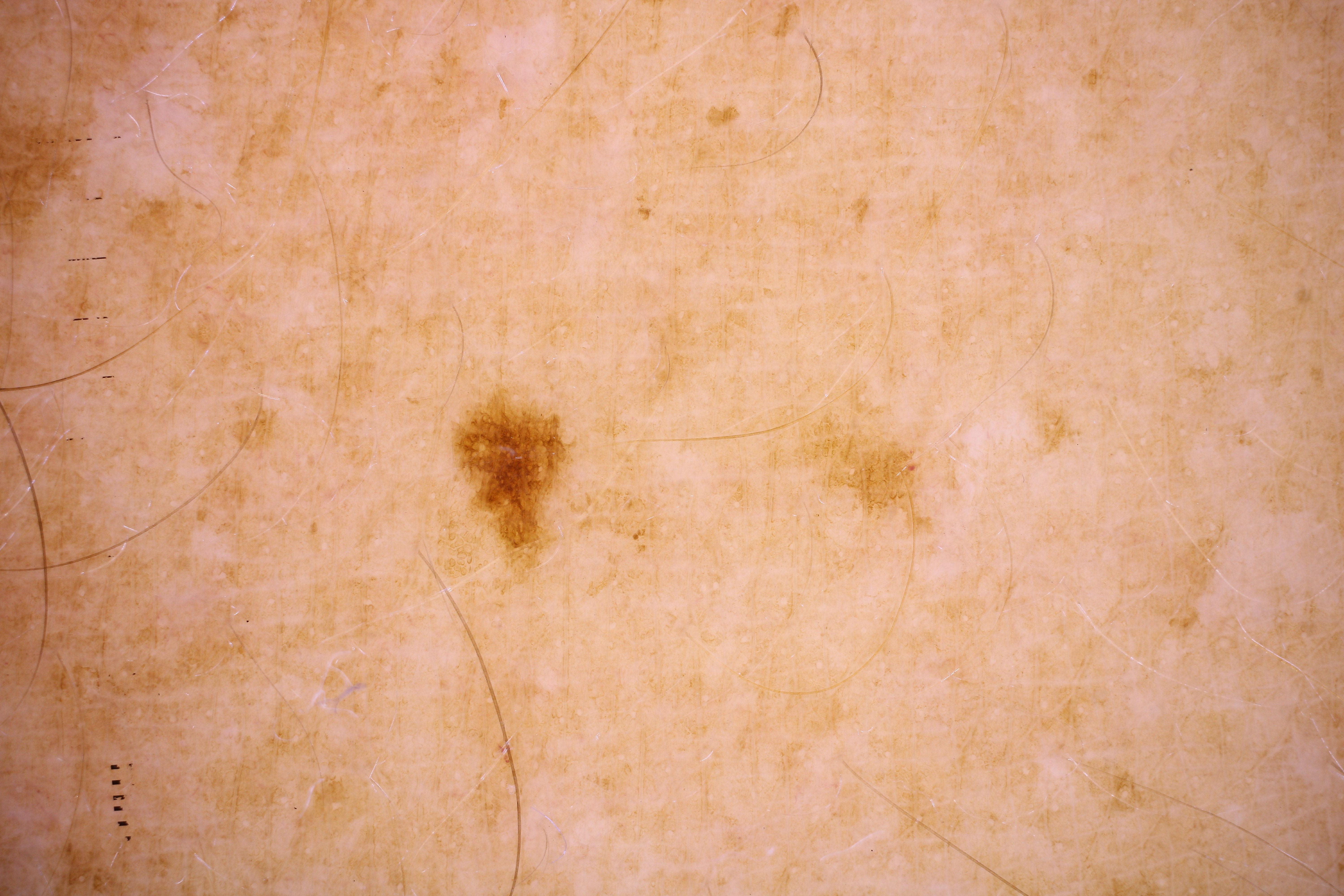 benign melanoma