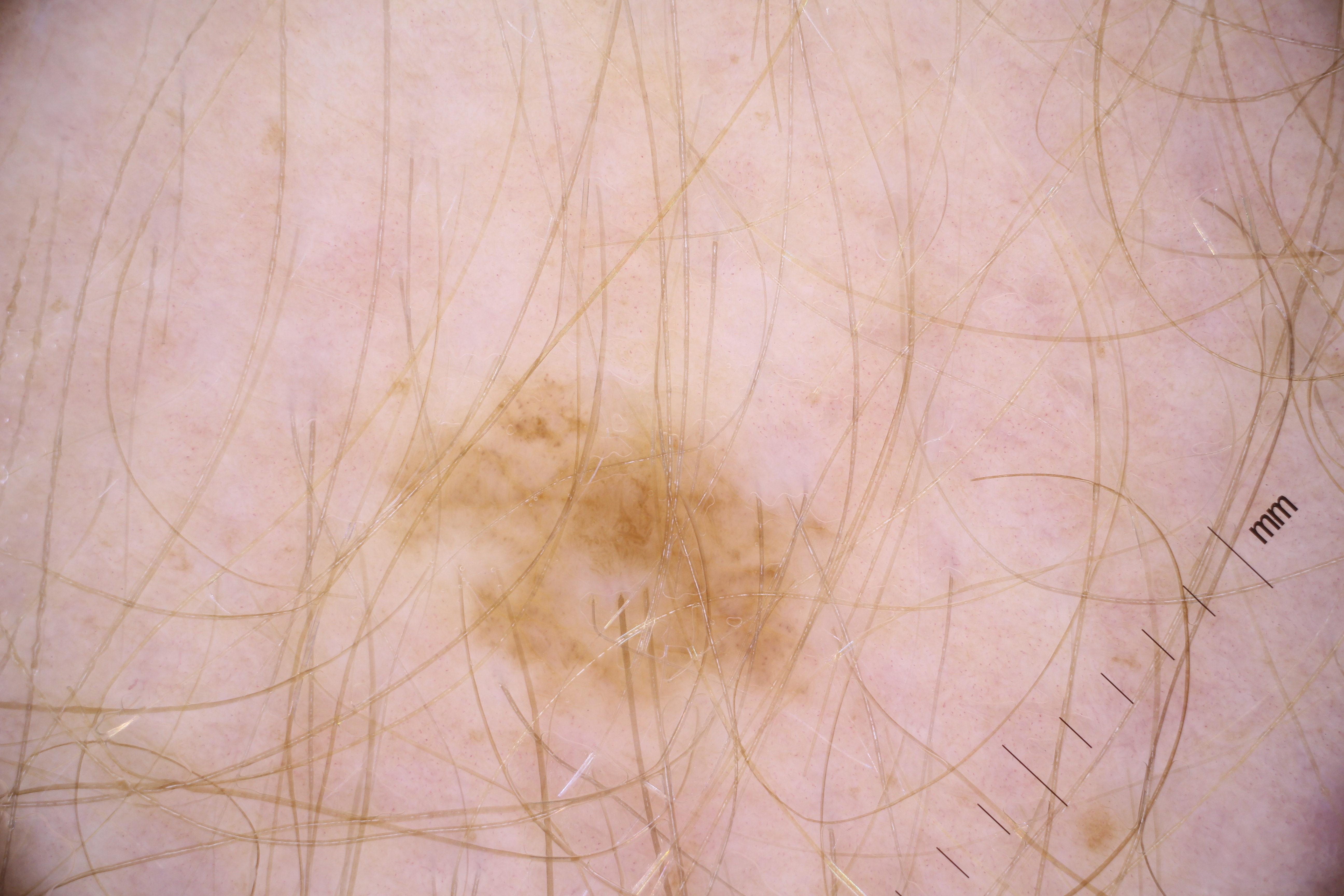 benign melanoma