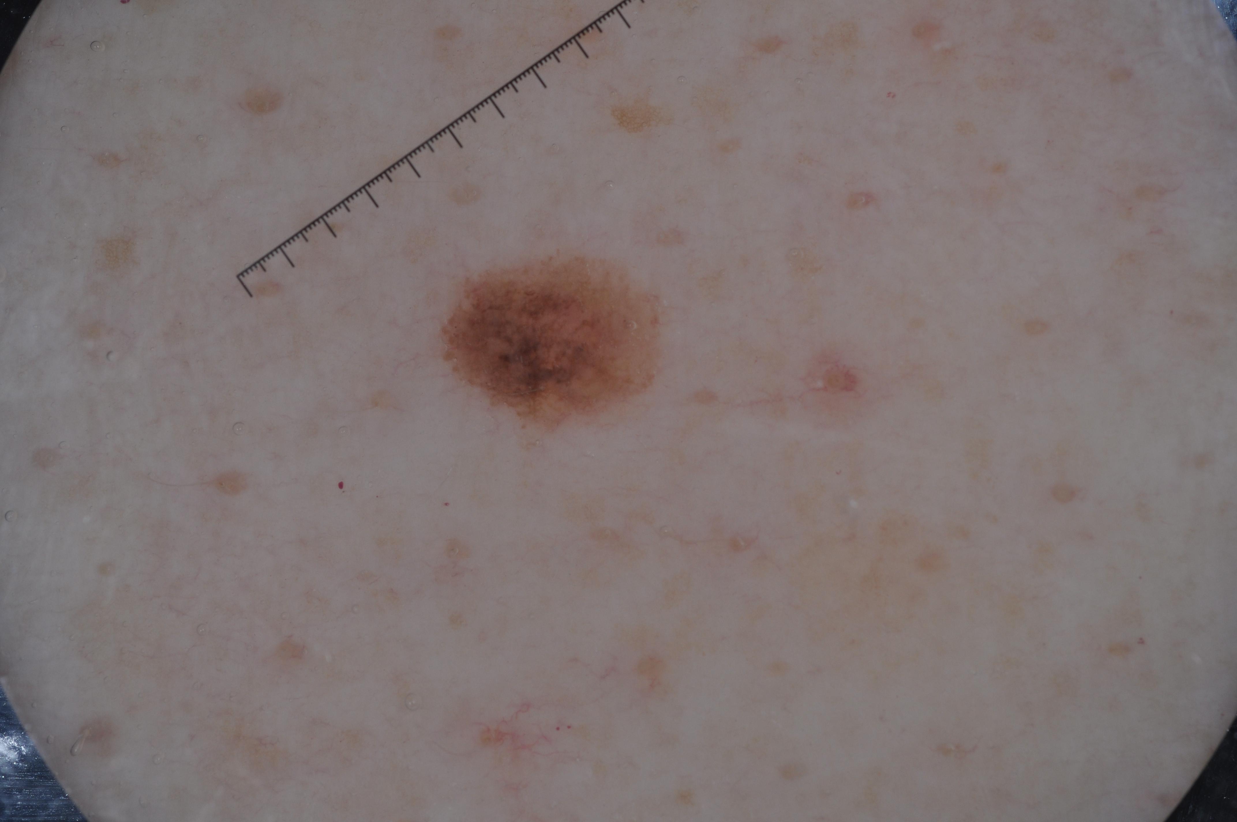 malignant melanoma