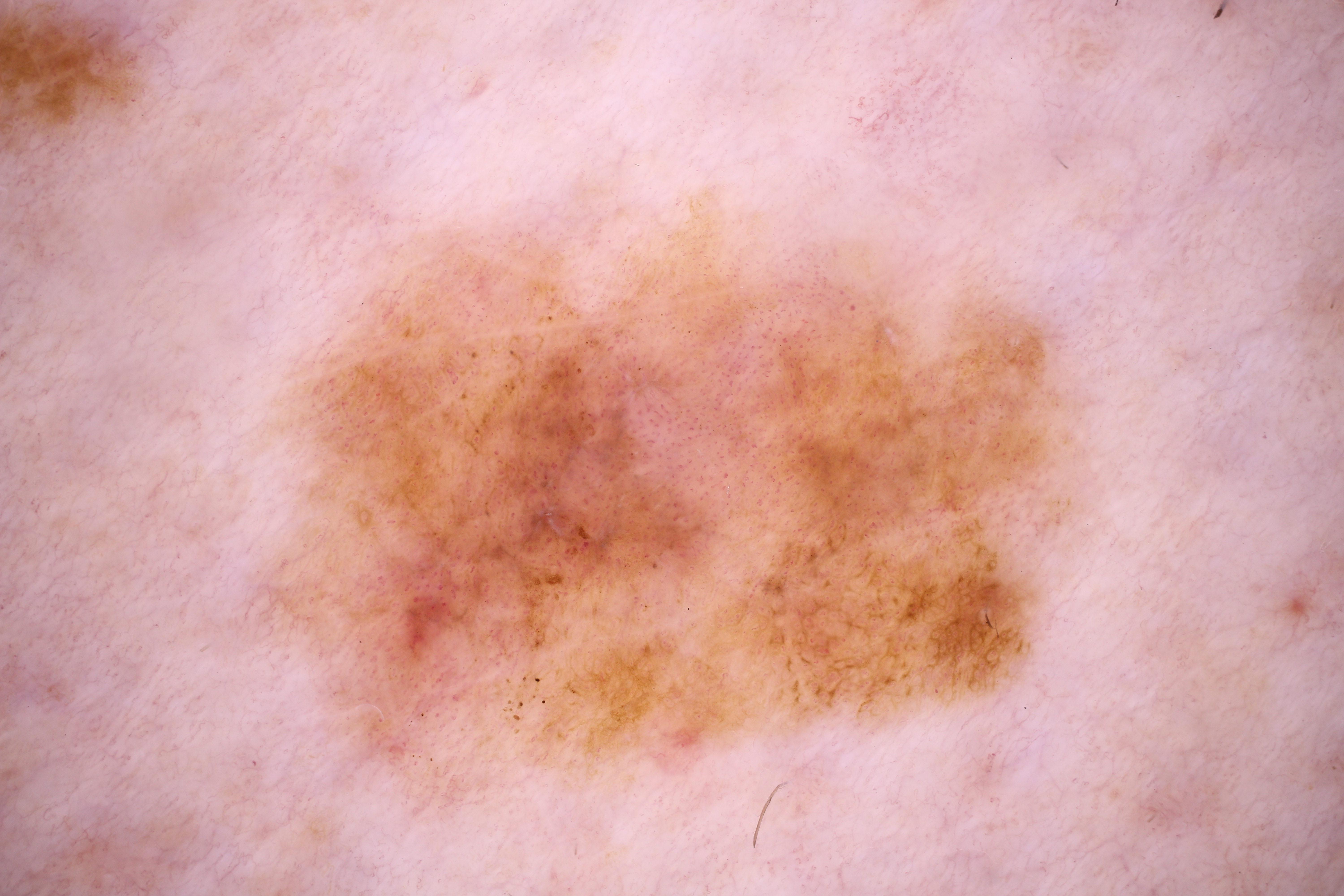 malignant melanoma