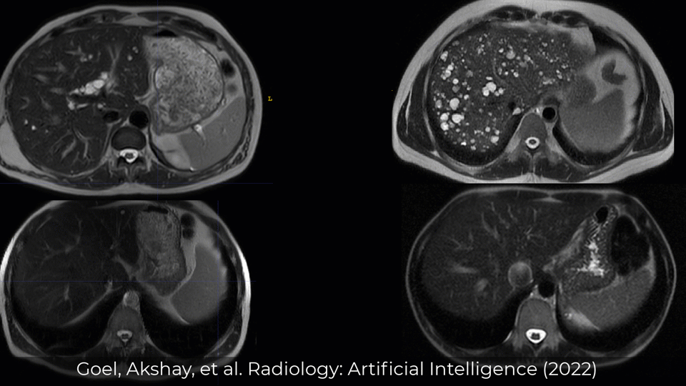 Example ADPKD MRI Data