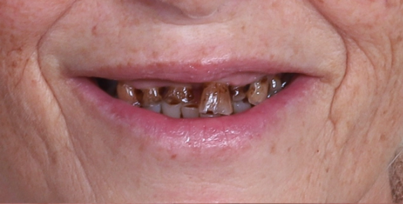 Antes — estado dental previo al tratamiento