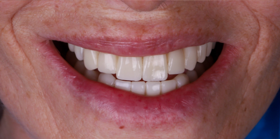 Después — resultado con implantes dentales