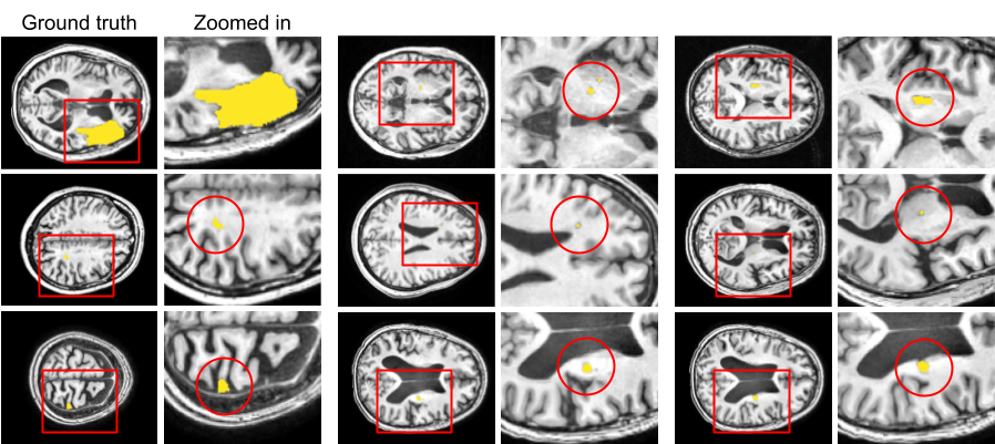 Small Lesion Segmentation in Brain MRIs with Subpixel Embedding (Oral)