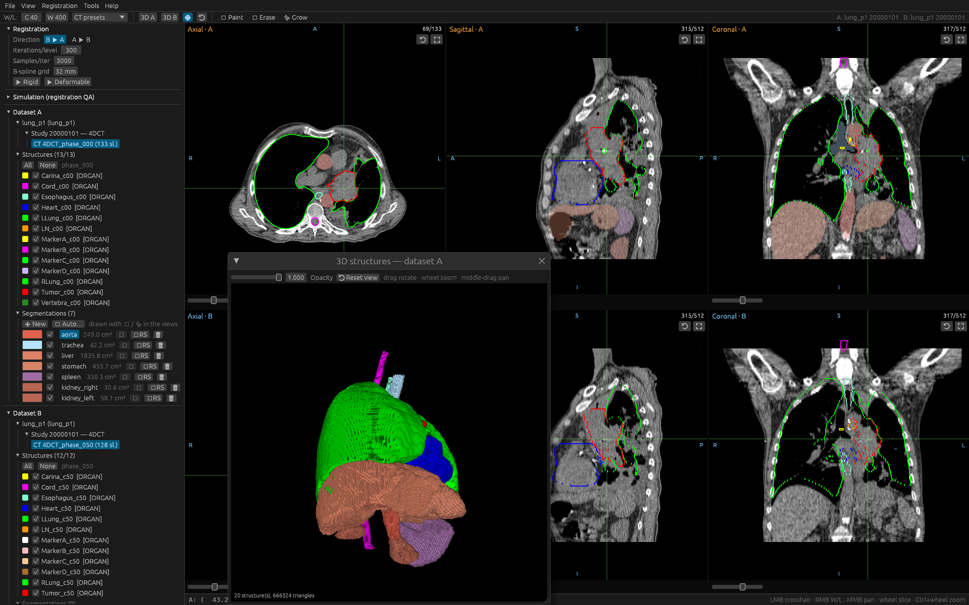 Rust DICOM Station showing linked MPR views and 3D structures