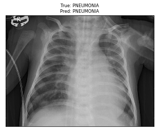 Pneumonia detector sample output