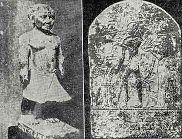 「Fig 23 Achondroplasia (left) & Poliomyelitis? (right). 図23 軟骨形成不全(左)、ポリオ?(右)」のキャプション付きの図