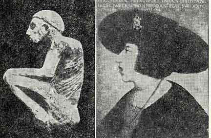 「Fig 24 Pott's Disease (left) & Adenoids (right). 図24 脊椎カリエス(左)、アデノイド(右)」のキャプション付きの図