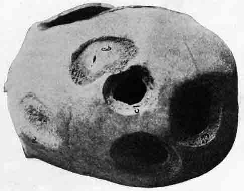 「第1図 以前と最近に穿孔術を行った結果を示す頭蓋骨」のキャプション付きの図