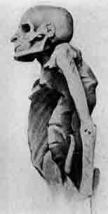 「第6図 脊椎が曲がっているミイラ」のキャプション付きの図