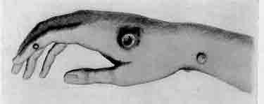 「第97図 牛痘を接種したサラー・ネルムスの手(ジェンナーのインクワイアリーより)」のキャプション付きの図