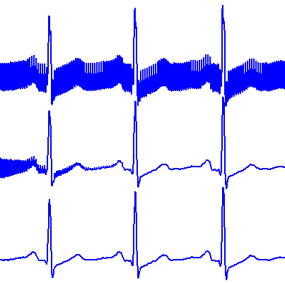 ECG filter usin an IIR notch filter with transient suppression