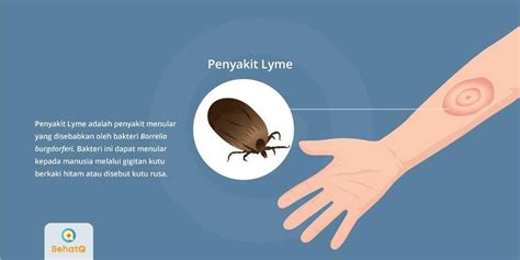 Tips Mudah untuk Mencegah Penyakit Lyme dan Terhindar dari Kutu