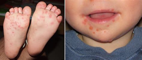 Mengenal Foot and Mouth Disease (FMD) pada Sapi: Gejala, Penyebab, dan Cara Penanganannya