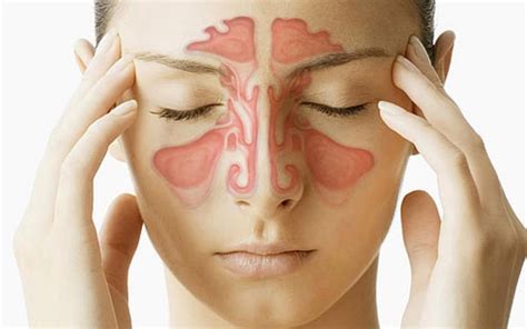 Sinusitis: Penyebab, Gejala, dan Cara Mengobatinya dengan Cepat