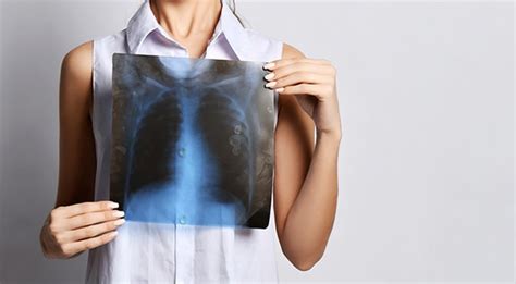 Bilateral Pneumonia: Penjelasan tentang Jenis Pneumonia yang Menyerang Kedua Paru-Paru