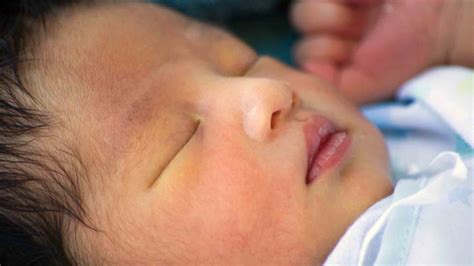 Cara mengatasi mata kuning pada bayi baru lahir