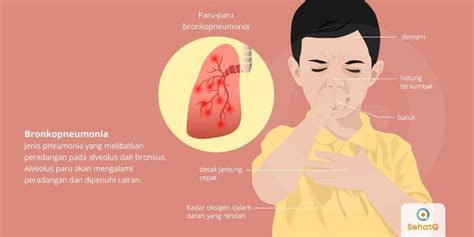 Pneumonia Bilateral: Gejala, Penyebab, dan Cara Mengobati Penyakit Ini