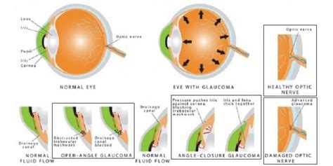 Memahami penyebab dan gejala penyakit glaukoma