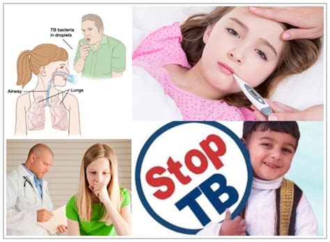 Tuberkulosis pada Anak-anak: Gejala, Penyebab, dan Cara Mengatasi Penyakit Ini pada Si Kecil