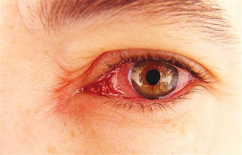 Mengatasi mata merah dan gatal pada anak