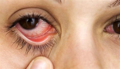 Kenali penyebab dan pengobatan sindrom mata kering