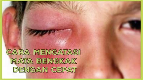 Bagaimana mengobati mata bengkak akibat alergi