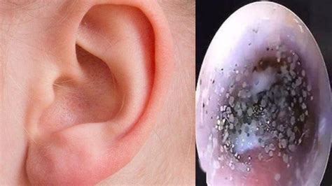Mencegah infeksi telinga akibat kebiasaan buruk