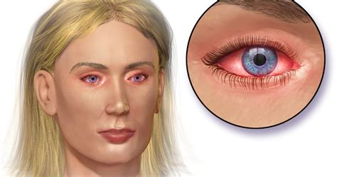 Cara alami mengatasi mata berair akibat alergi