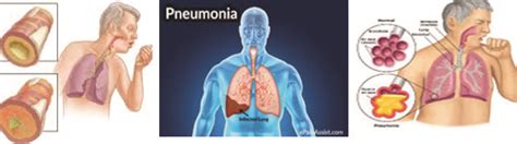 Perbedaan Tuberkulosis dan Pneumonia: Penjelasan tentang Gejala, Penyebab, dan Cara Mengatasi Kedua Penyakit Ini