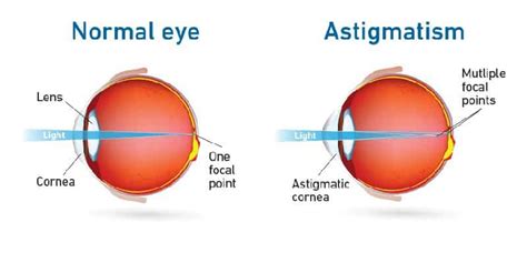 Tanda-tanda dan pengobatan penyakit astigmatisme pada anak-anak
