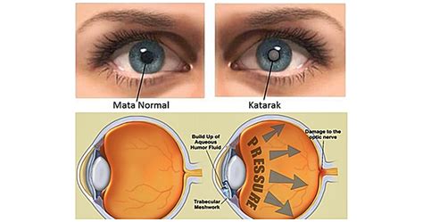 Jenis-jenis penyakit mata pada usia lanjut dan cara mencegahnya