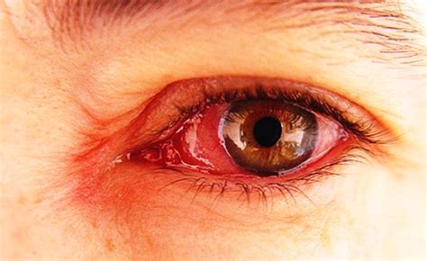 Mengenal jenis-jenis penyakit mata dan cara mencegahnya