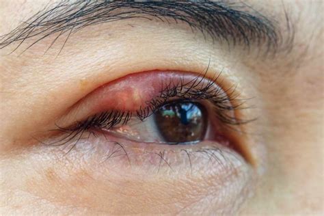 Tips mengatasi kelopak mata yang sering berkedut