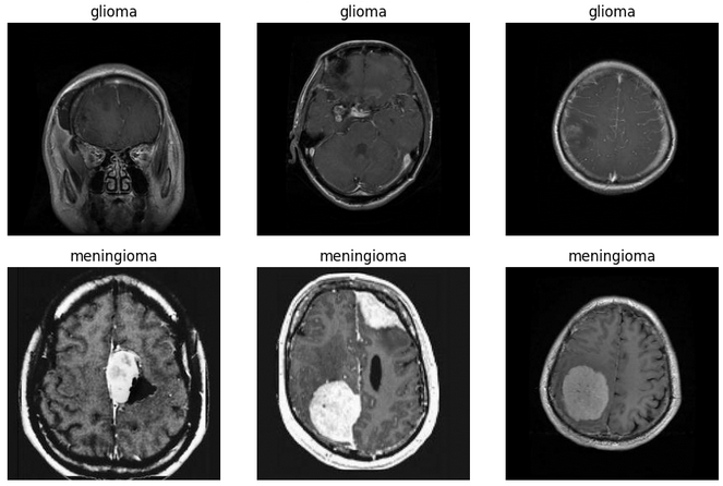 ML Brain Tumor Detection Thumbnail
