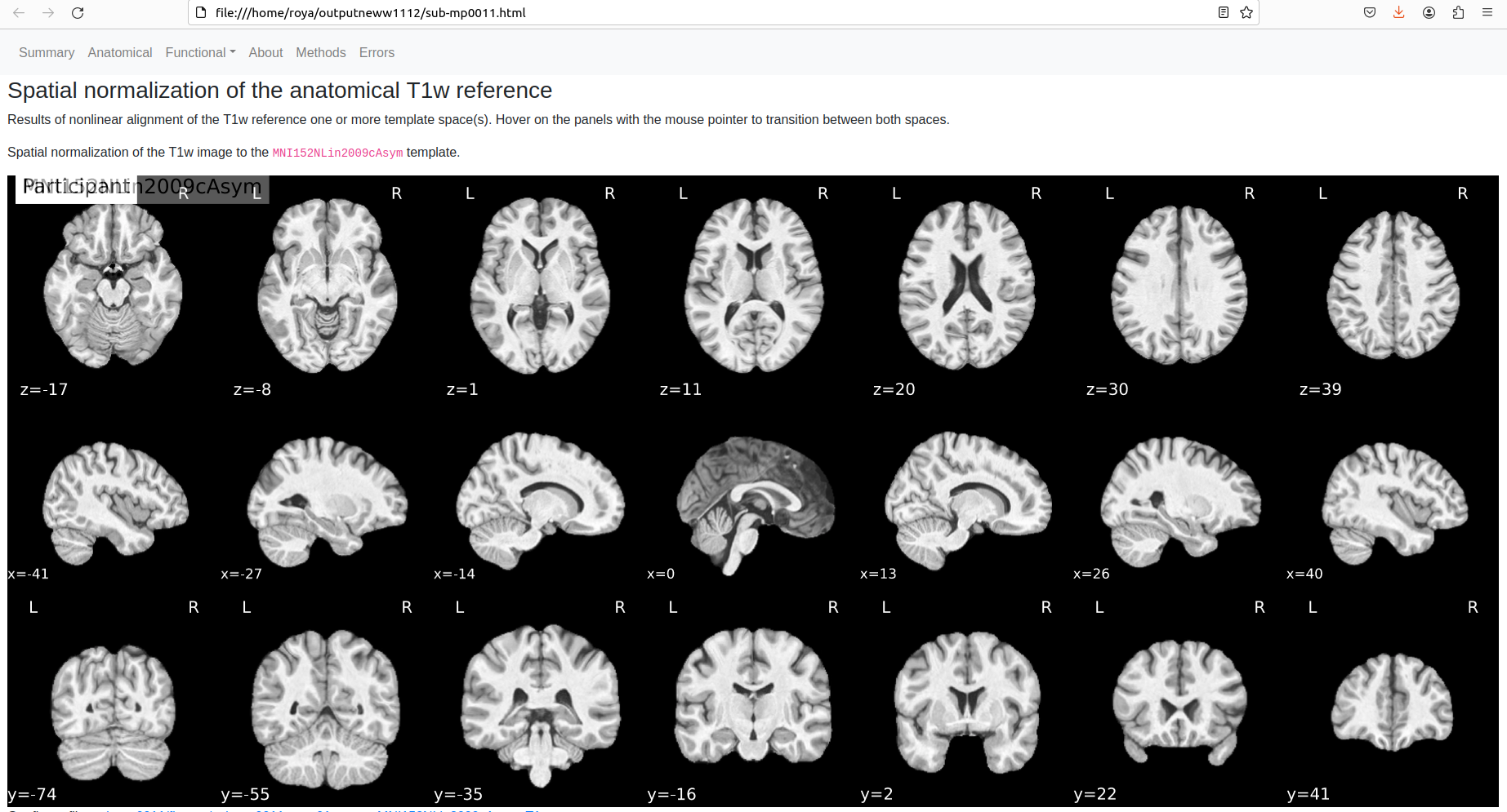 Spatial-normalization-fmriprep